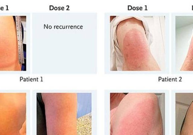 الكشف عن سبب الطفح الجلدي الأحمر الذي يظهر على أجسام من يتلقون لقاح كورونا