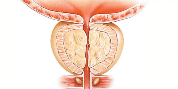 3 معلومات مهمة عن تضخم البروستاتا الحميد