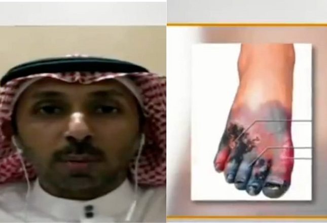 شاهد: استشاري يوضح كيف يعرف مريض السكر أنه مُصاب بالقدم السكرية.. ويكشف متى يضطر الطبيب للبتر