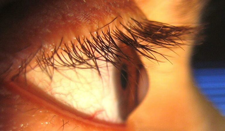 ‏استشاري: الوراثة ​وفرك العين يؤديان للإصابة بالقرنية المخروطية.. وهذه مضاعفاتها وطرق علاجها