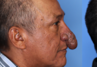 أمريكي يخضع لعملية تجميل في أنفه الغريب.. شاهد كيف ظهر بعد الجراحة الناجحة