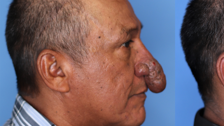 أمريكي يخضع لعملية تجميل في أنفه الغريب.. شاهد كيف ظهر بعد الجراحة الناجحة