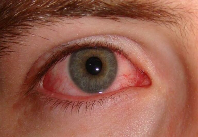 مرض معد يصيب العين.. فهد الطبية توضح ما هو التراخوما وأعراضه وكيفية العلاج منه