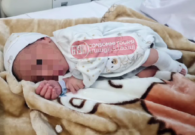 بالصور: ولادة نادرة لطفل يحمل شقيقه التوأم داخل بطنه