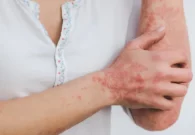 10 أشياء يجب تجنبها عند ظهور أعراض الصدفية