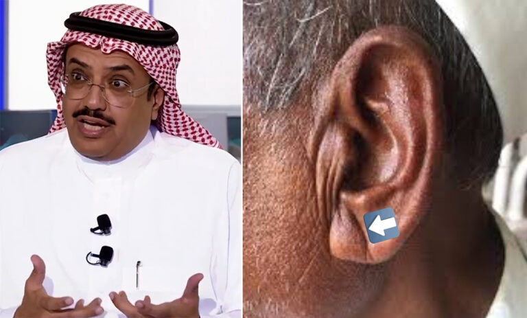 هل هناك علاقة بين تضخم شحمة الأذن والإصابة بجلطات القلب؟.. النمر يجيب