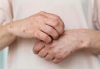 اكتشاف طبي مبهر: تركيبة فعّالة لعلاج الإكزيما وتهيّج فروة الرأس -فيديو