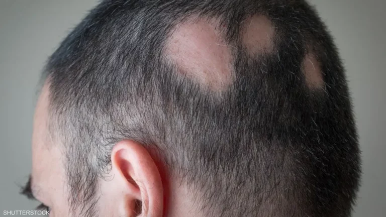 أخيرا.. علاج الثعلبة البقعية متاح الآن عبر هيئة الخدمات الصحية الوطنية البريطانية