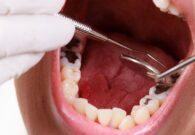 اكتشاف وصفة طبيعية للتخلص من تسوس الأسنان وإزالة الجير – شاهد طريقة بسيطة يكشفها طبيب
