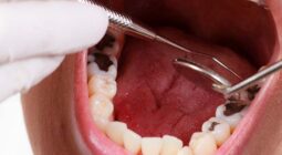 اكتشاف وصفة طبيعية للتخلص من تسوس الأسنان وإزالة الجير – شاهد طريقة بسيطة يكشفها طبيب